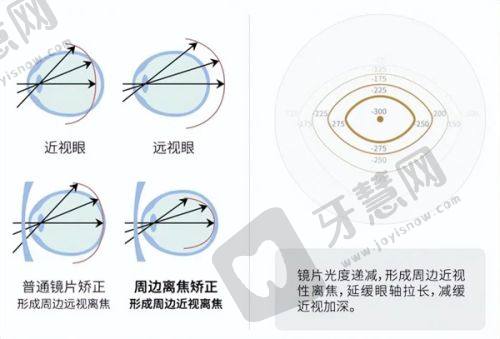 佛山高明爱尔眼科医院收费情况