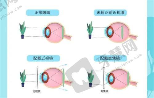 亳州爱尔眼科医院的正规性