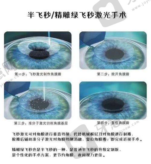 贵州省人民医院近视手术价目：飞秒1.6 - 2万+晶体3.2万起可预约
