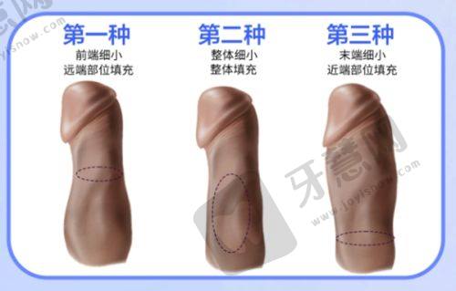 总结建议:广州医 科 大学一附院私密整形值得选择