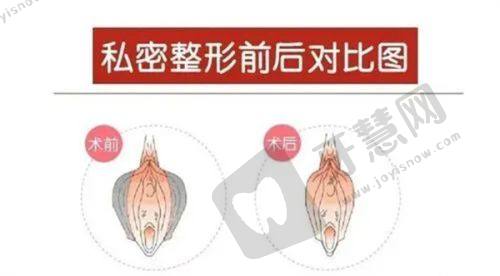 打了生长因子三年后疯长的原因及危害