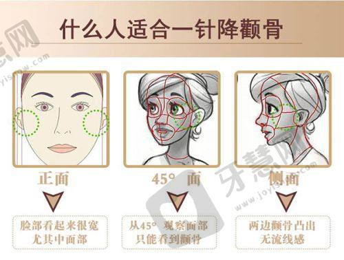 2025郑州王杨医生简历揭秘：眼袋修复卧蚕技术超绝案例多附收费