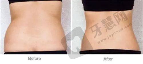 揭秘达州星美高良杰医生：美体塑形专长及吸脂填充精湛技术
