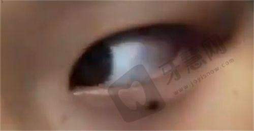润致2号玻尿酸：中等硬度，塑造清晰轮廓