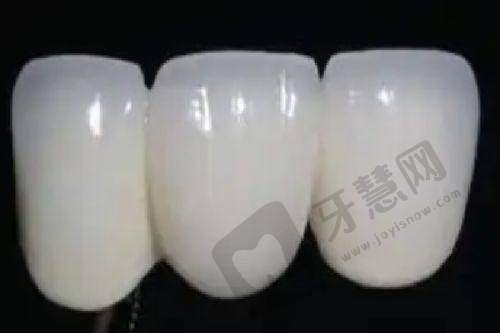 上海苏齿博信口腔贴片牙齿多少钱一颗——患者实例见证