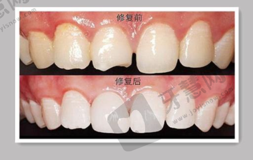 无锡佳士洁口腔(清扬店)做全瓷牙套多少钱一颗？德国美牙冠2500元起体验优质服务