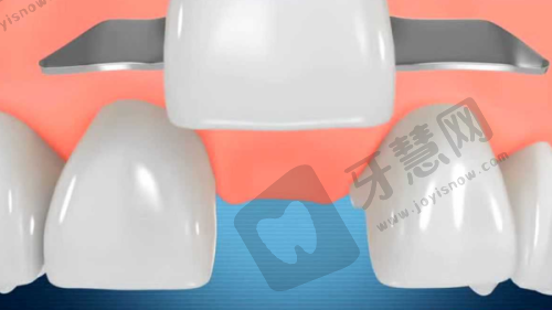 上海苏齿博信口腔做烤瓷牙套多少钱一颗牙？金属600起全瓷2000起医院优势多