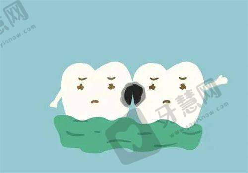 厦门博德口腔门诊部贴片牙齿多少钱一颗——患者实例分享
