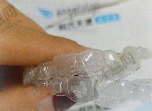 上海苏齿博信口腔牙套矫正总结与建议