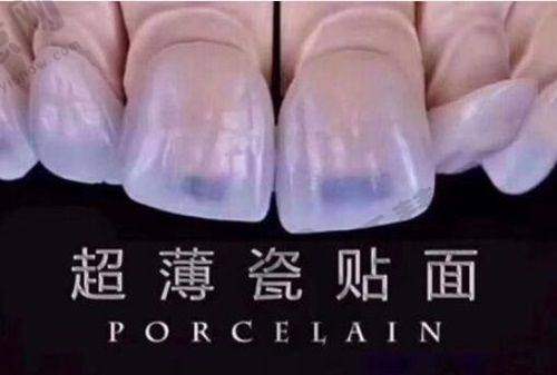 湖南永州冷水滩雅美口腔门诊部做全瓷牙套的优势