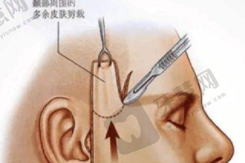 上海伯思立医疗美容医院双眼皮整形项目效果怎么样？医生技术佳价格合理患者口碑好