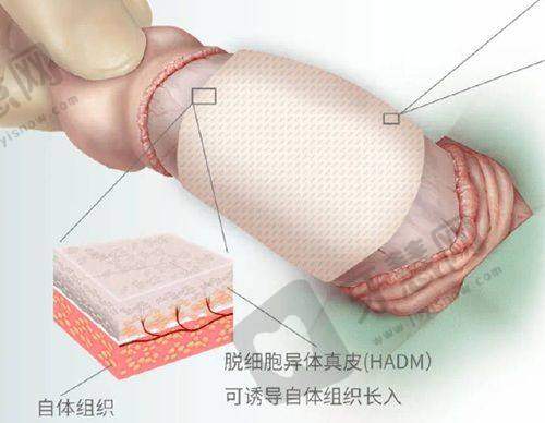 半岛超声炮副作用、后遗症及治疗前后注意要点