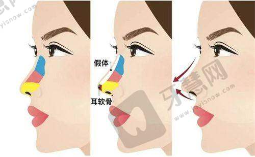 重庆松山整形医院怎么样，朱乐林医生手术效果好吗？正颌磨骨效果优价格还亲民