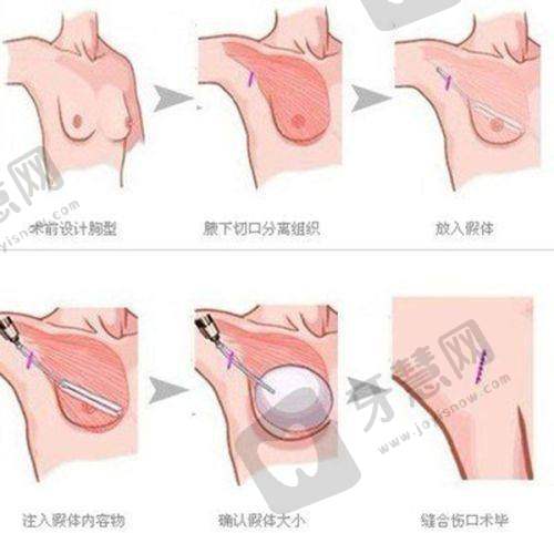 半岛超声炮注意事项有哪些