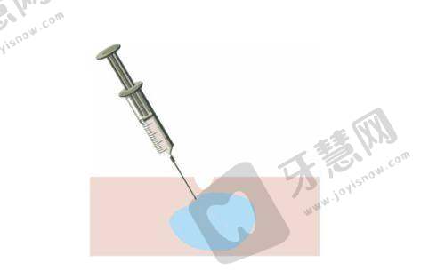 碧莲盛植发总结:综合考量,理性选择