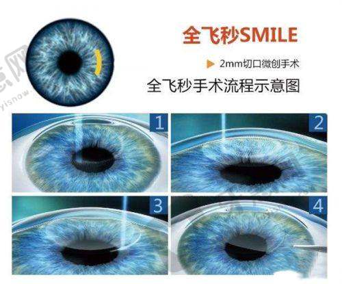 重庆爱尔眼科矫正近视优势尽显