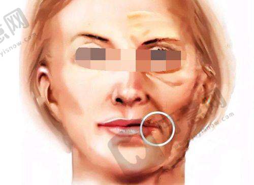 三、广州富贵包治疗正规医院选择建议