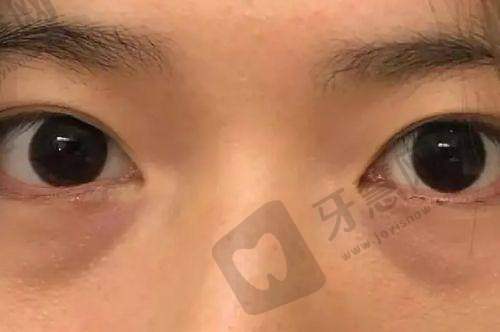 面部骨骼不对称怎么办？正颌/下颌角/下巴三种主流矫正方案解析