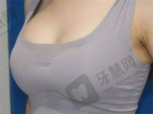 南通隆胸好的整形医院中做傲诺拉假体丰胸的有这几家——傲诺拉假体优势