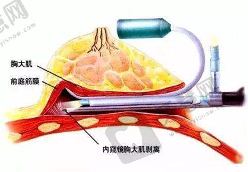 南通玻尿酸注射除皱医院价格:选择医院建议