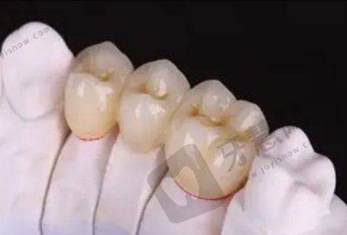 常州全烤瓷牙多少钱一颗？多颗烤瓷牙收费情况