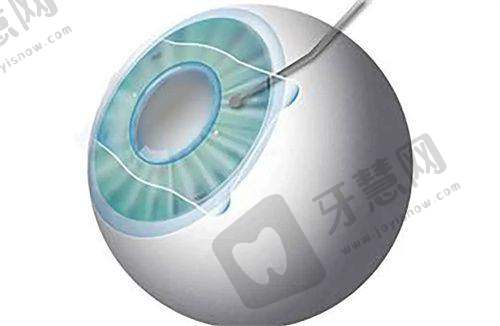 北京大学深圳医院眼科口碑好不好?附真实患者口碑评价