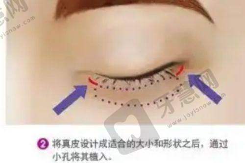 郑永生医生——2025修复双眼皮的专精典范