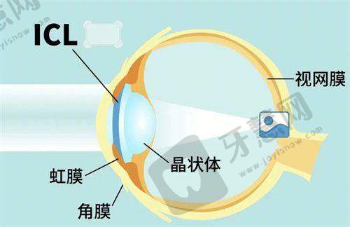 宁波市眼科医院近视眼手术价格表查询，全飞秒15800元起ICL晶体植入28500元起