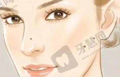 鼻子假体品牌排行榜中美迪菲假体情况