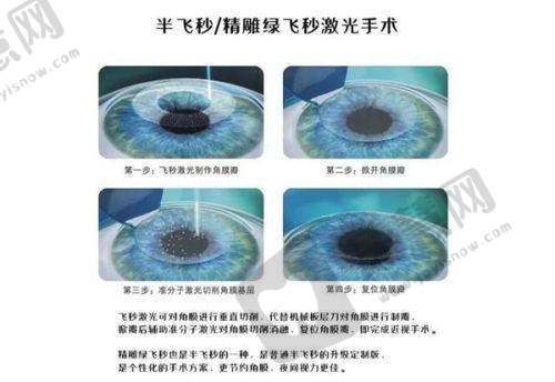 2025年爱尔眼科近视手术价目表详情：150 - 1800度全价位攻略，真人案例见证效果，速来预约挂号