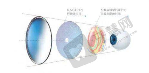 2025年爱尔眼科150度到1800度近视手术全价位攻略内容:ICL晶体手术解析