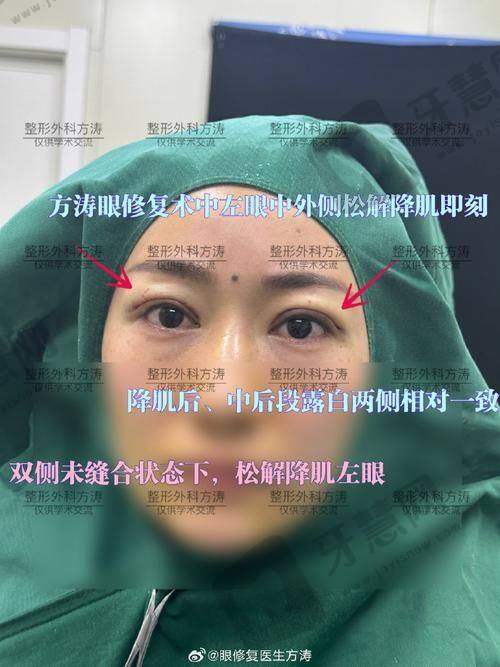 韩昱华医生擅长的面部年轻化项目