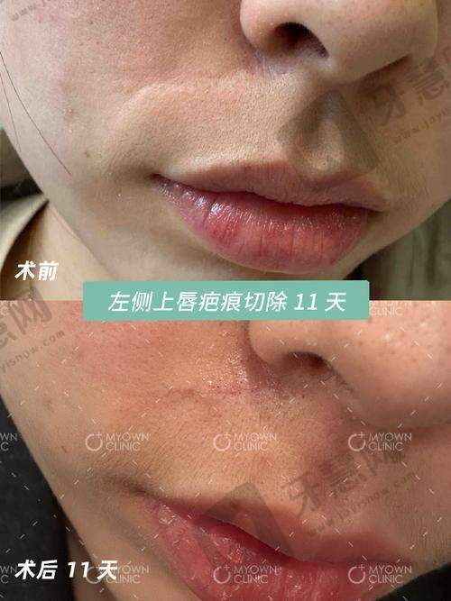沈阳华美疤痕医院预约挂号