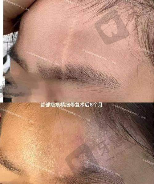 沈阳华美疤痕医院价格表/收费标准2025年