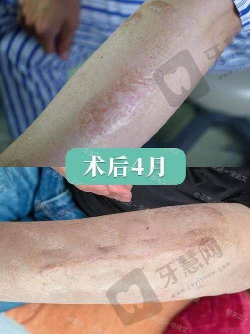 沈阳华美疤痕医院口碑如何
