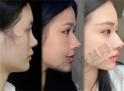 李琳医生鼻修复技术好牛很多人预约，广州医疗美容助您重塑自信美鼻