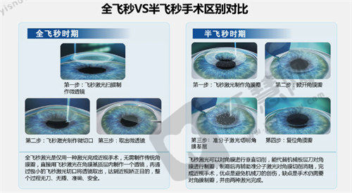 中山爱尔眼科近视矫正手术价格透明，多种术式可选且医生技术优口碑好