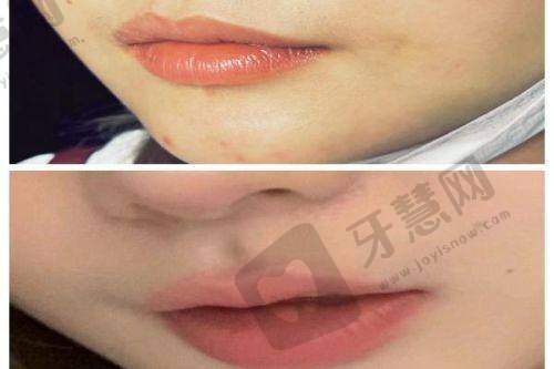 师丽丽医生双眼皮修复技术的显著优势