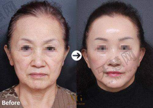上海华美杨亚益医生 - 美学设计双眼皮骨干医生