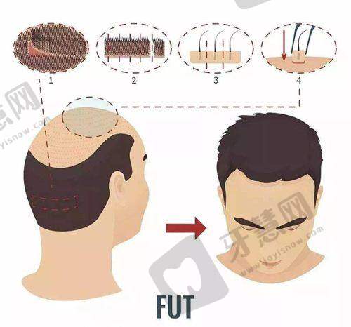 北京丰联丽格整形医院师丽丽院长修复双眼皮实例