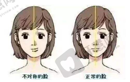 北京丰联丽格师丽丽肉条眼修复实例分享：解决肉条困扰