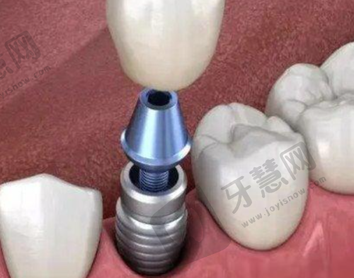 北京中诺口腔医院种植牙医生技术优势剖析