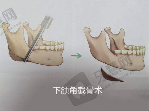 实例2：眼袋修复 + 眶隔脂肪释放，50岁求美者重获年轻眼周