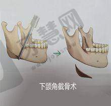 三、先天发育不良乳房矫正术：8大核心优势，铸就自然挺拔美胸