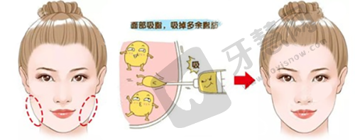 广州荔湾区人民医院:清奥技术佼佼者