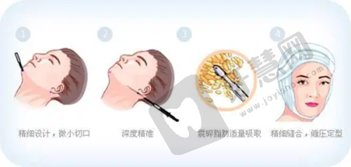 二、李衍江副主事团队：20年乳房整形经验，万例手术零事故