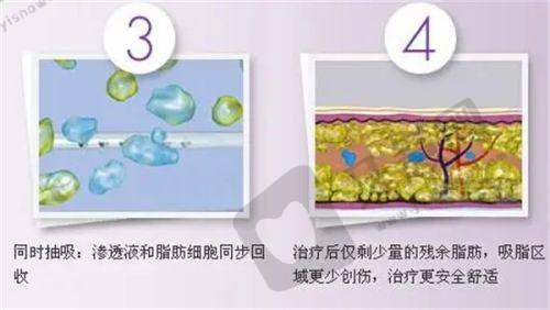 沈阳百嘉丽李衍江副主任先天发育不良乳房矫正术22000元起，术后自然挺拔像天生