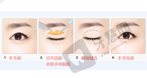 八爪鱼紧缩术图片之术后修复情况