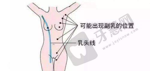 二十四种B型状示意图之海葵型解析