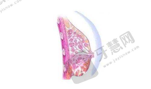 实例3：上睑下垂矫正，改善“抬眉睁眼”困扰